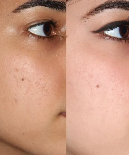 Dry and damaged skin transformed with organic skincare products before and after