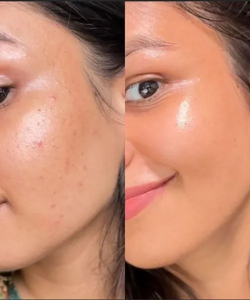 Before and after organic skincare routine for clear, smooth, and radiant skin